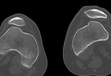 Chronic Patella Dislocation 1